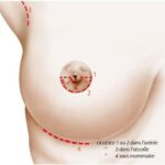 cicatrice augmentation mammaire