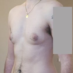 mastectomie transgenre